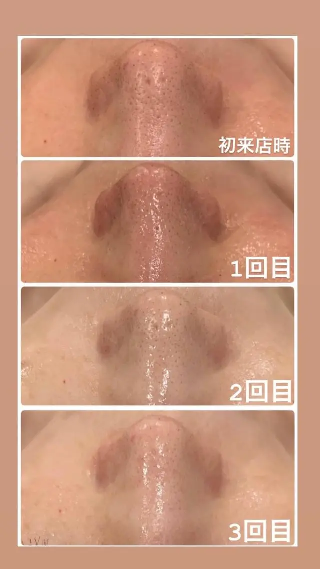 リピーター様用✨剥けない、痛くない、ダウンタイム無し🌿ハーブピーリングで肌育。トラブル知らずなツヤ肌を作ります🩵の写真