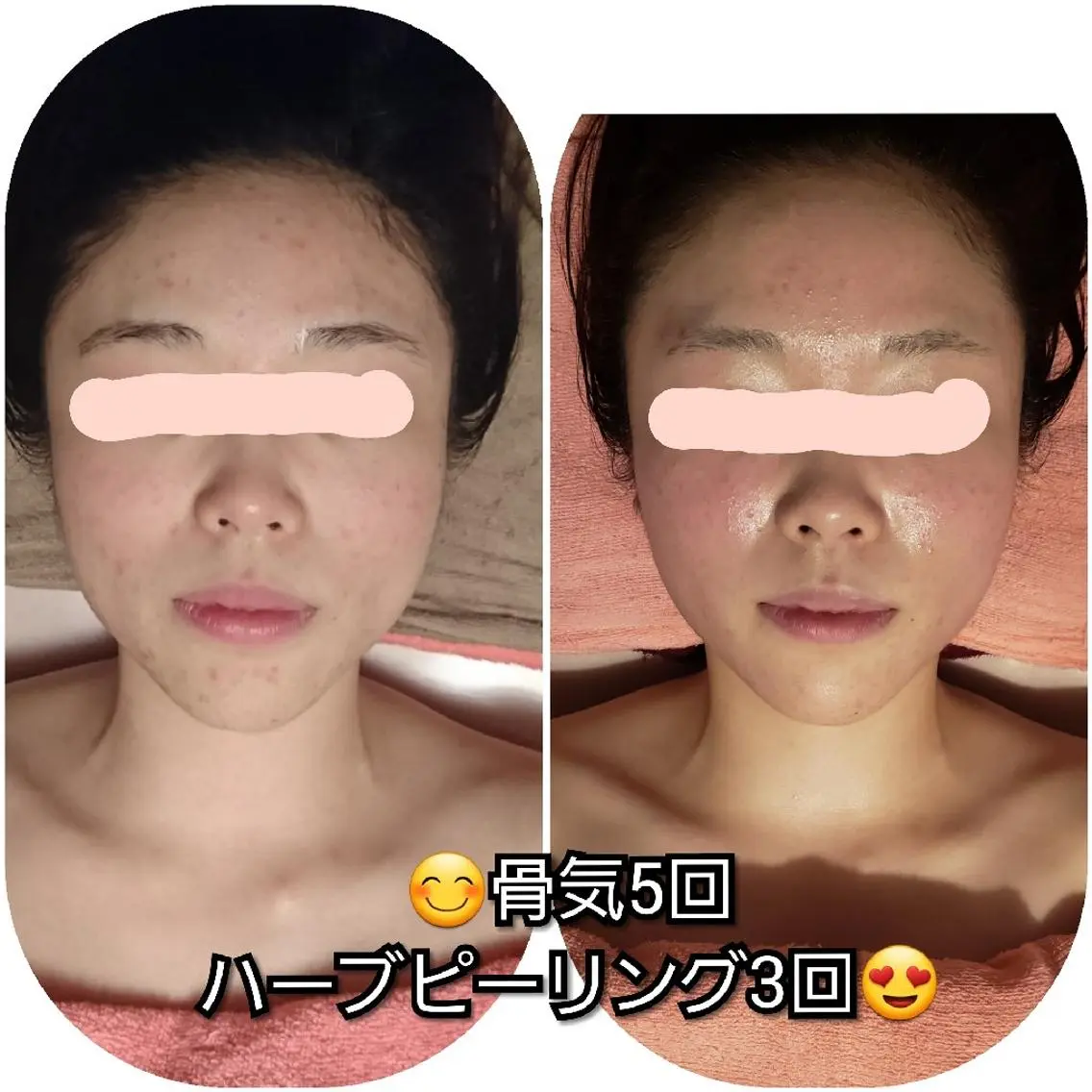 ミニモ限定！骨気｜小顔・リフトアップ効果💎首肩デコルテマッサージ付きで癒しも◎￥7000→6600の写真