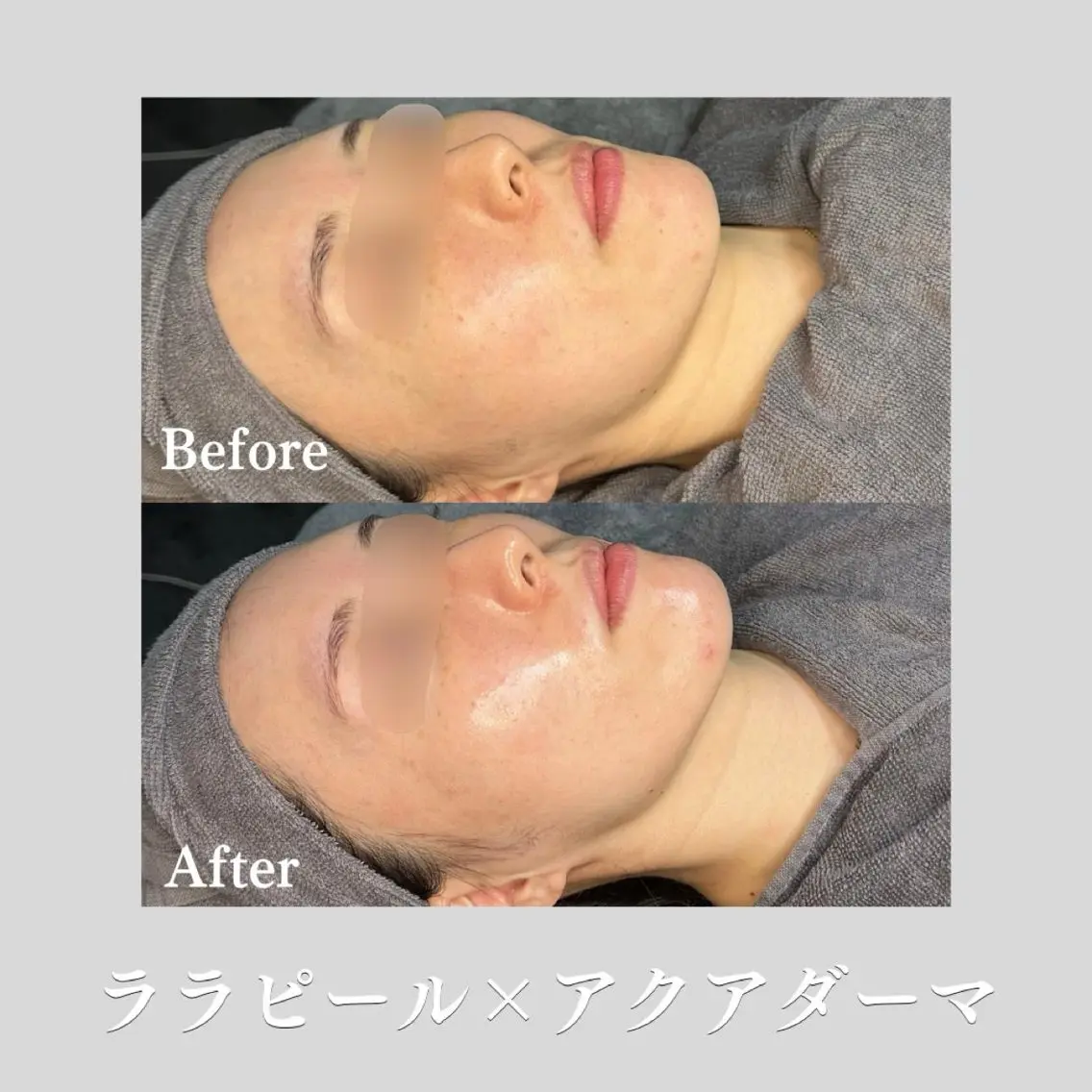 第4世代ピーリング【ララピール】✖️【アクアダーマ トラネキサム酸美容液】美肌美白ケア💎の写真
