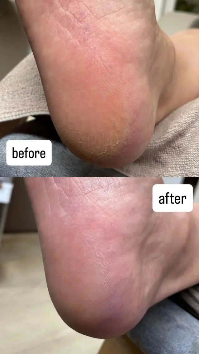 フットケア✨️足裏の角質ケア&フットマッサージのセットメニュー!の写真