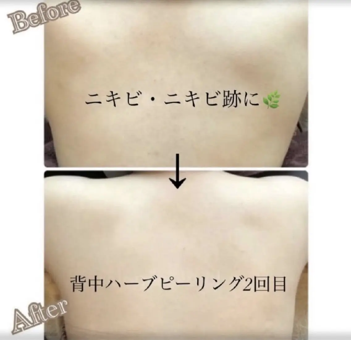 背中ニキビ・ざらつきに！【背中ハーブピーリング🌿+美背中パック】¥6980の写真