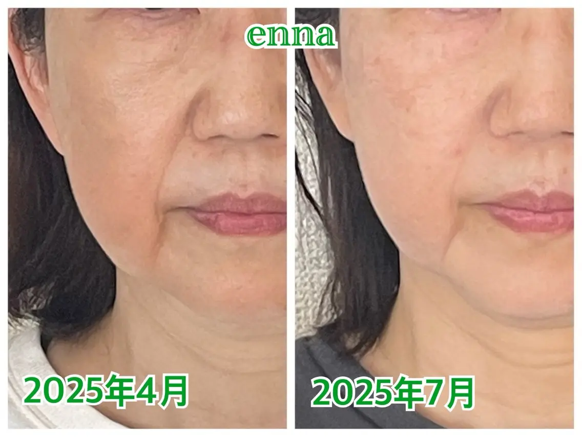 【ほっぺ集中ケア】厚く重くなりがちなホホをシュッとスッキリ!の写真