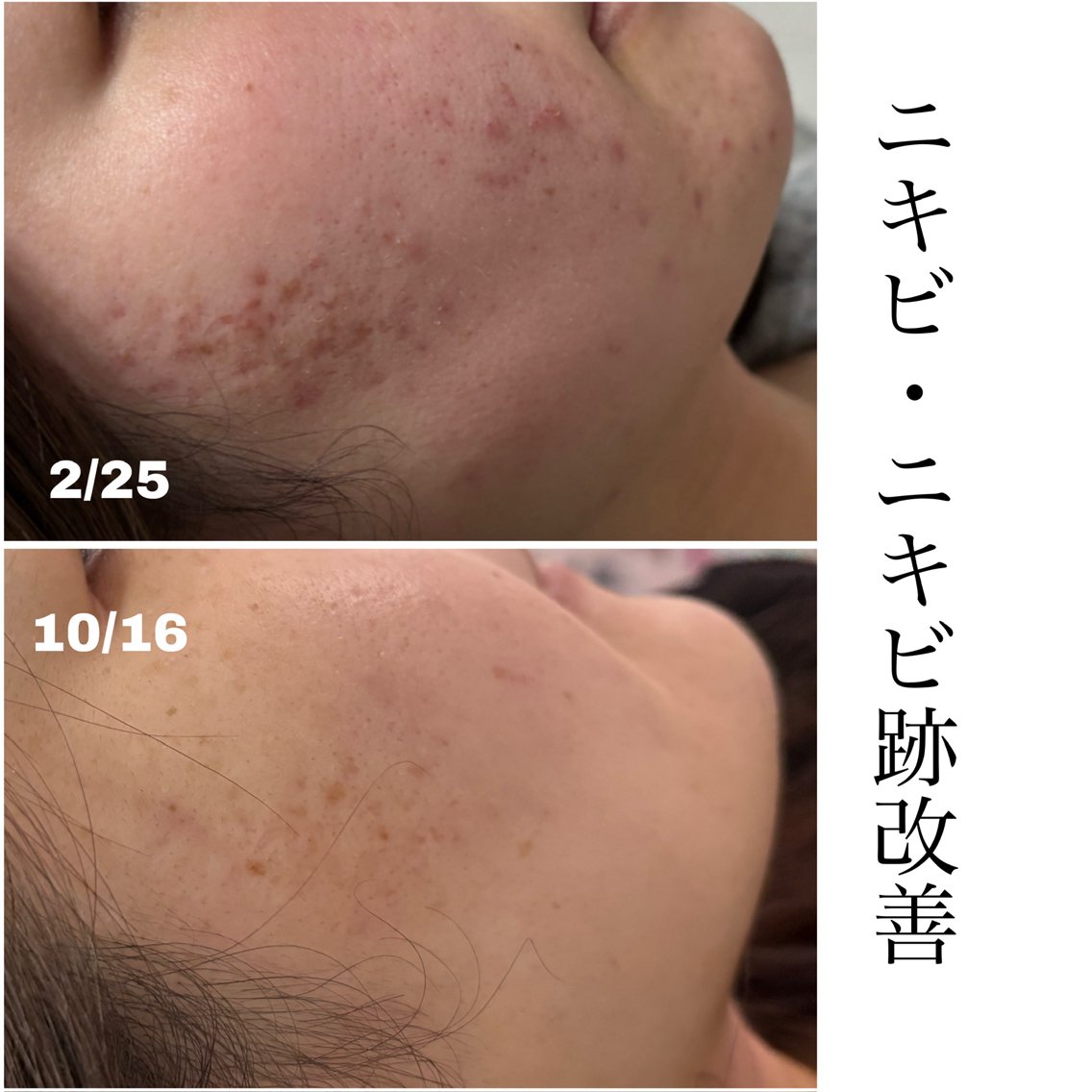 【ニキビ・ニキビ跡さん必見‼️】 本気の肌質改善エステ🤍の写真