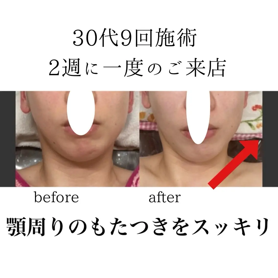 シミニキビ改善 小顔脱毛サロンのエステ・リラクイメージ