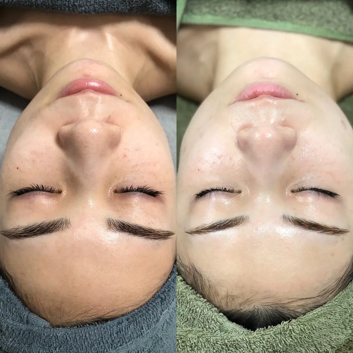 まずはお試し♪REVI（ルヴィ）の剥けないハーブピーリング【陶肌トリートメント】スタンダードコースの写真