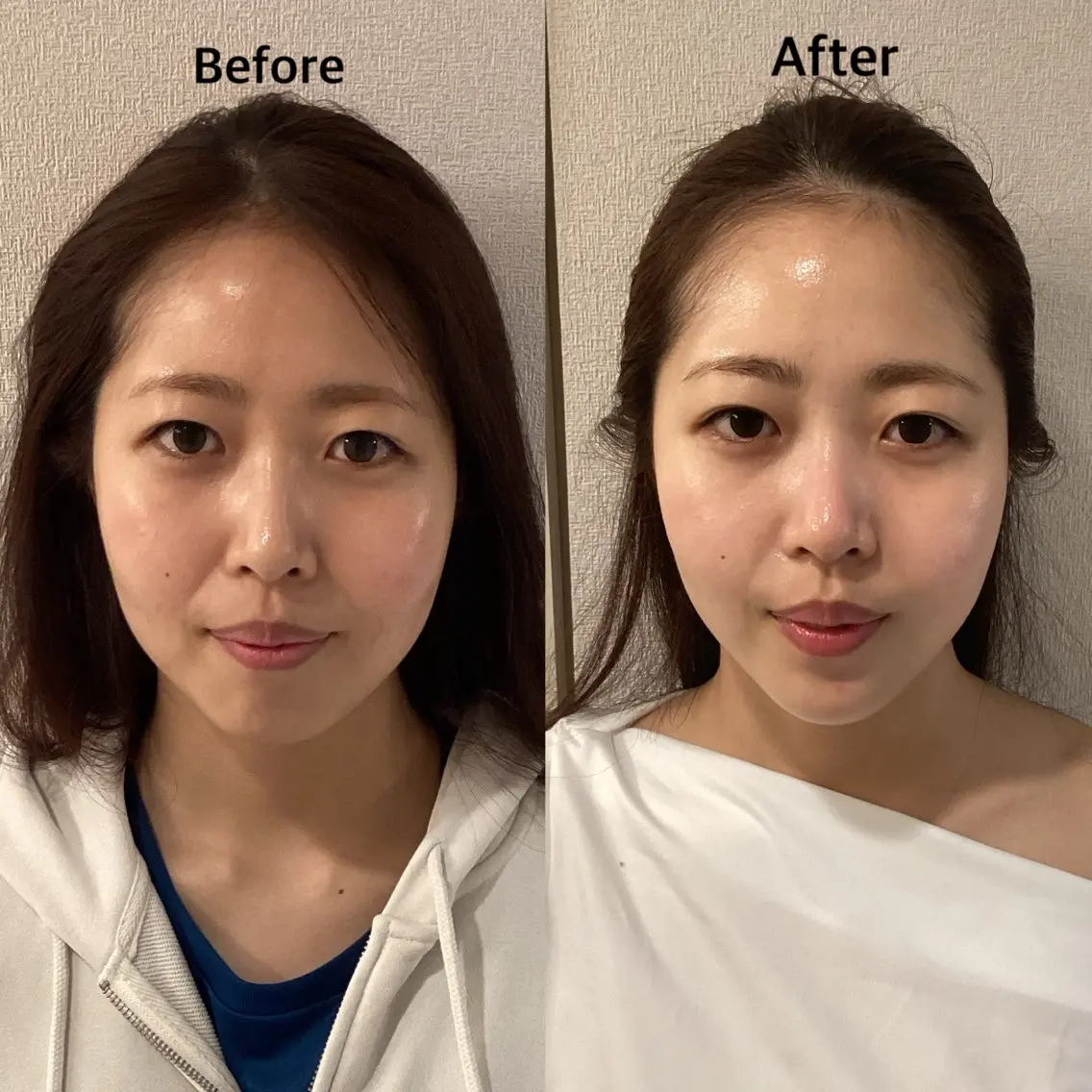 【人気No.1♡】土台から整えるBUPURA式小顔ケア✨の写真