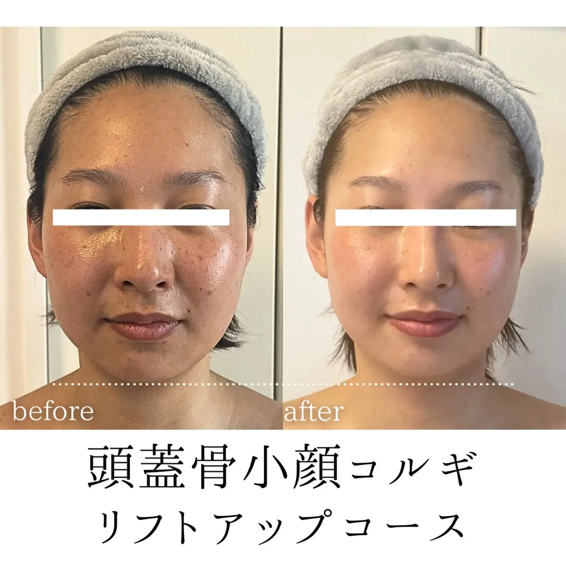 リフトアップコース【即小顔実感リフトアップ】頭蓋骨小顔コルギ60分の写真