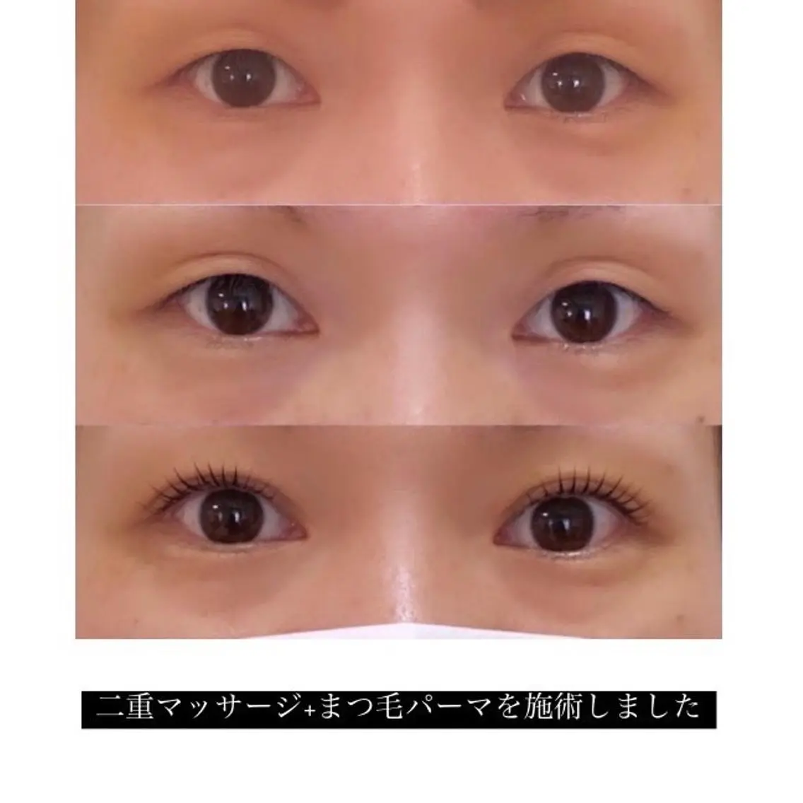 切らずに二重✨ダブルアイリフトの写真
