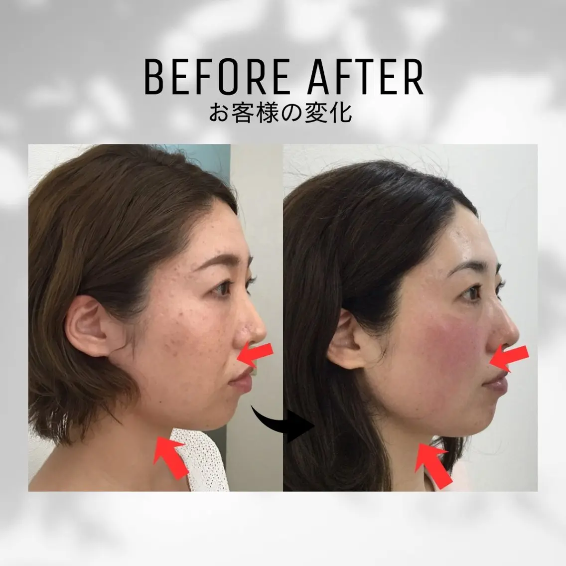 【もたつきフェイスラインに♡】小顔ケア×表情筋EMSの写真