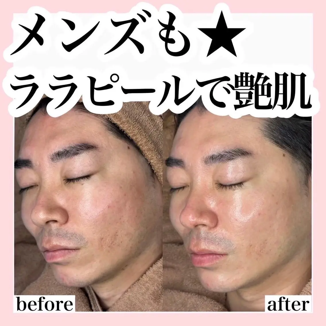 【メンズ専用】ララピール💎毛穴悩み・乾燥・色素沈着・エイジングケアとしてご利用ください🤍✨の写真