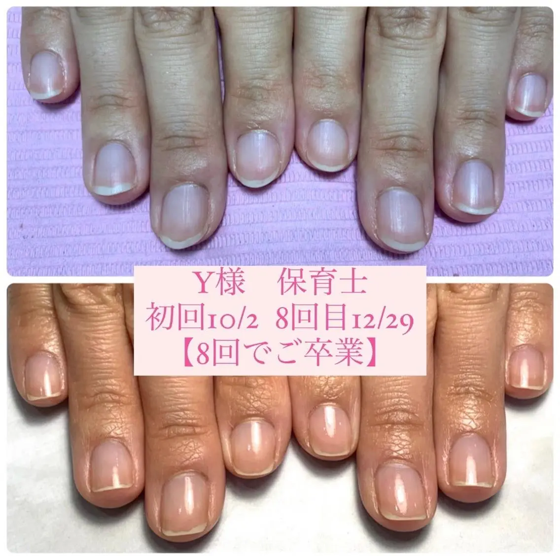 ネイル 自爪育成/深爪矯正 mikiのネイルデザイン