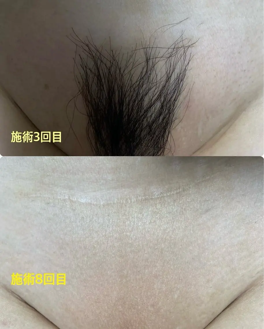 脱毛 脱毛サロン Laughのエステ・リラクイメージ