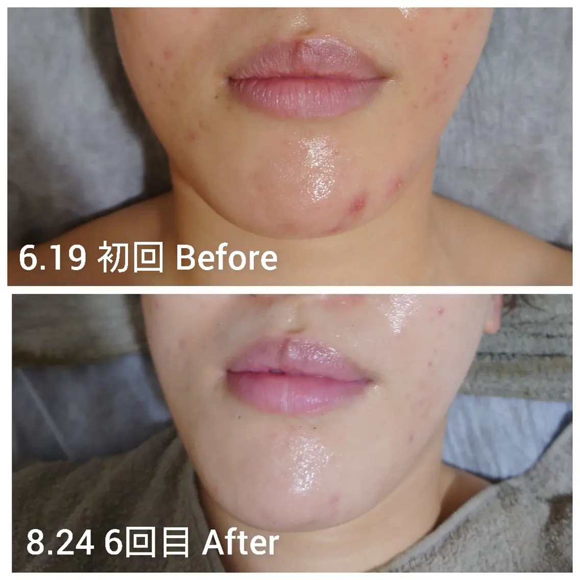 《REVハーブピーリング》ニキビ、毛穴、お肌のゴアつきケアケア！マッサージ付！オプション¥4400相当プレゼント☆の写真