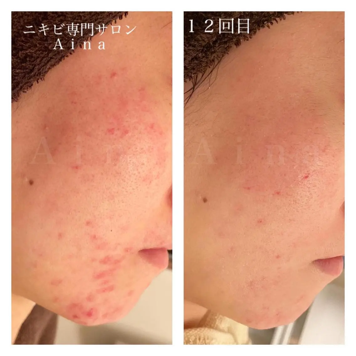 セミロング カラー パーマ ヘアアレンジ メンズ キッズ ネイル マツエク・マツパ クリアネイル 赤色 エステ リラク ニキビ跡専門サロン Ainaのエステ・リラクイメージ