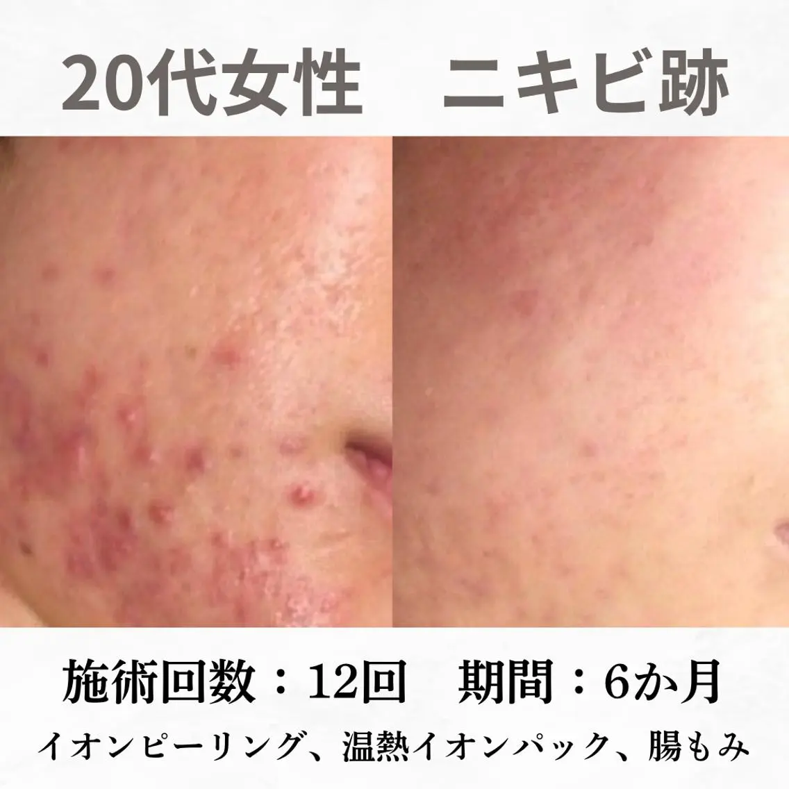 重度ニキビ専門🌼 ダウンタイムなしのエステ・リラクイメージ