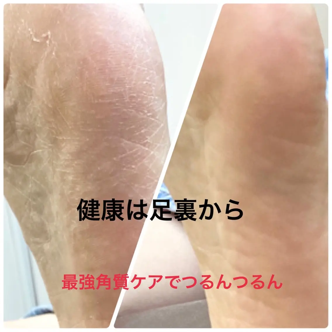 一度でわかる!大好評の角質ケア🌸機械でつるつる✨足の角質ケアの写真