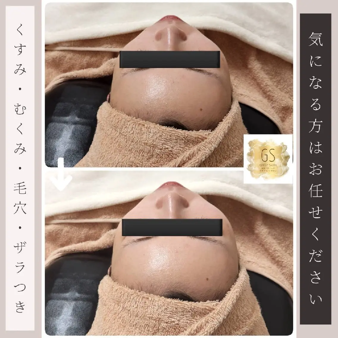 【当店で最上級美白ケア】ハーブピーリングダブル+毛穴洗浄+ポレーションの写真