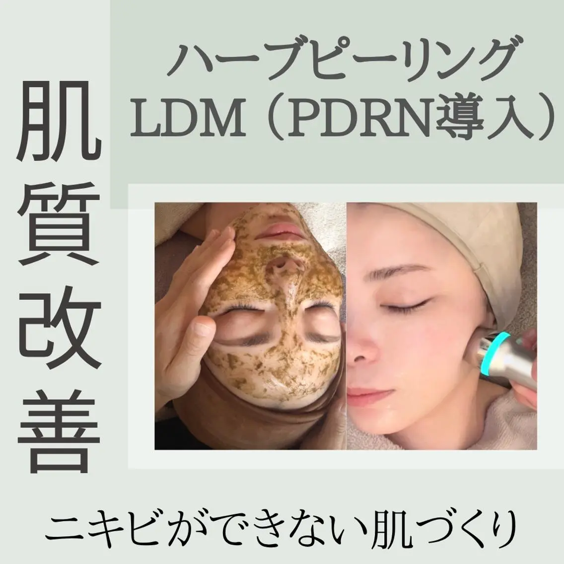 【ニキビ赤み肌＆ひらき毛穴】ハーブピーリング🌿×LDM×PDRN導入の写真