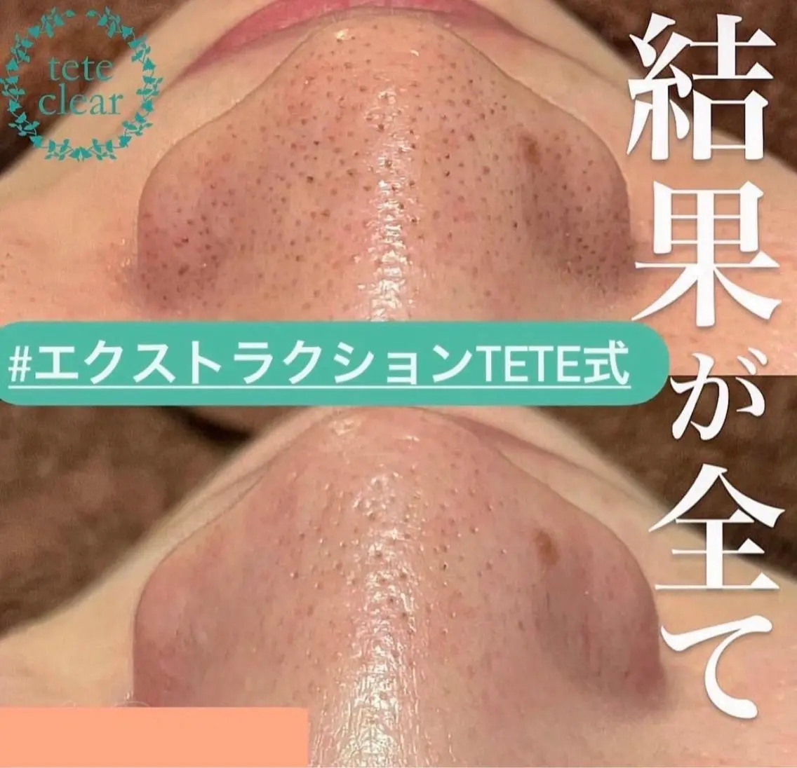 いちご鼻さようなら!毛穴美人コース!無添加なので敏感肌の方にもオススメです♡毛穴ケア➕リンパマッサージでスッキリ100分の写真