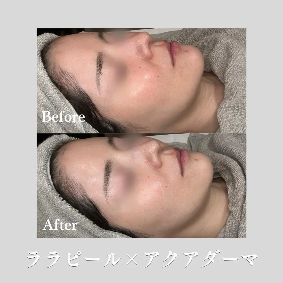 ✨ ララピール+アクアダーマ(💧うるおい美容液導入)の写真