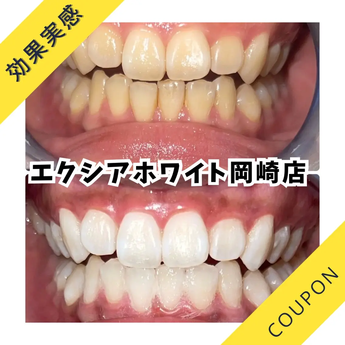 【人気No.1】高濃度プレミア歯科ホワイト90分通常¥14,300円→¥12,100円✨️【コーティング付き40分照射】の写真