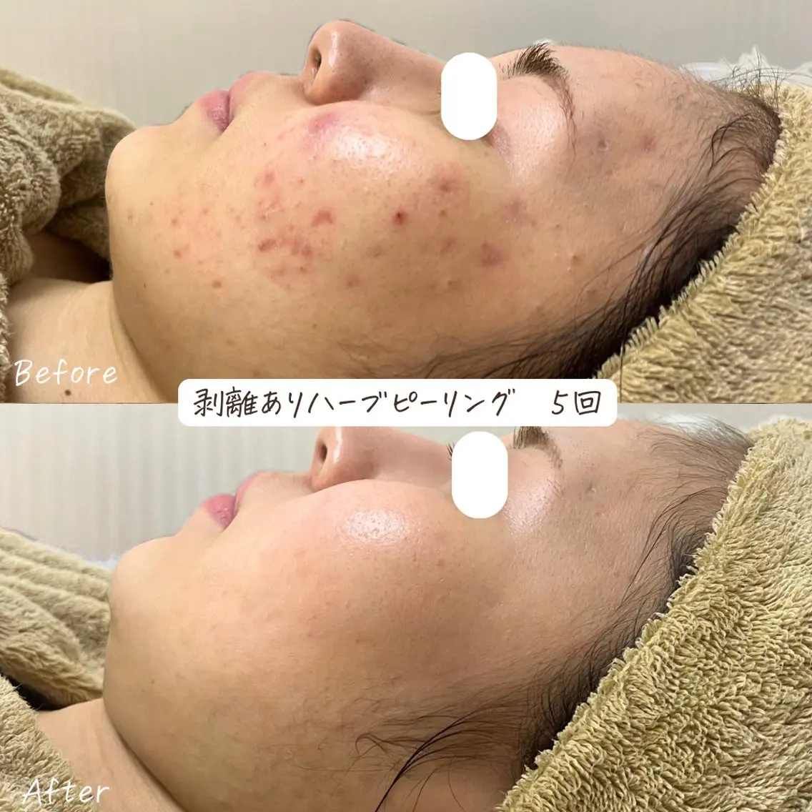 肌質改善サロン renew/ウエキのエステ・リラクイメージ