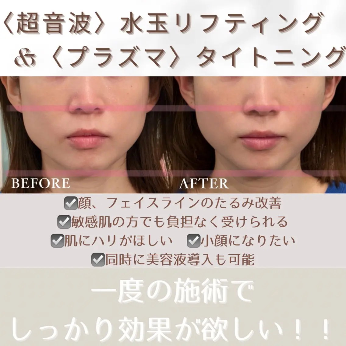 《お写真モニター募集》【超音波】水玉トリプルリフティング+【プラズマ】タイトニングの写真