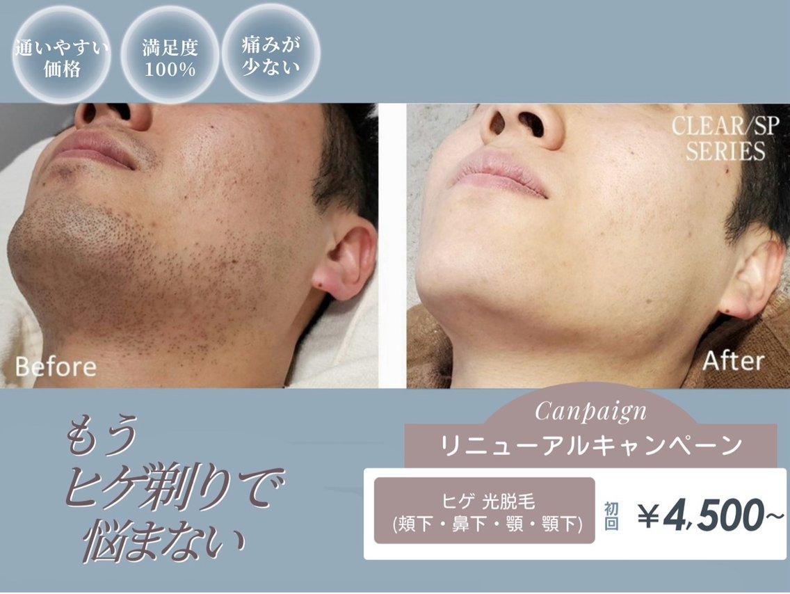 【メンズ】ヒゲ光脱毛の写真