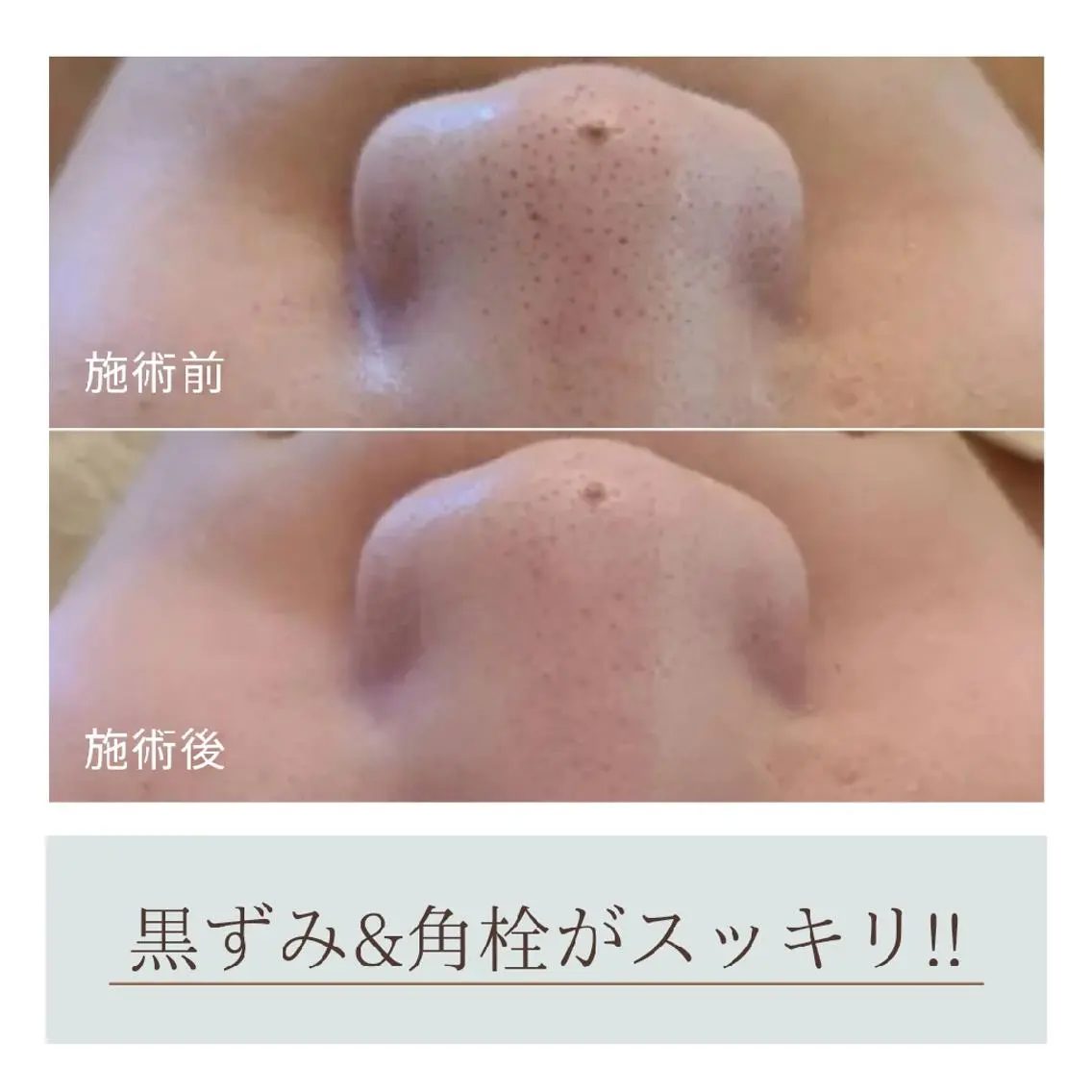 小顔&毛穴撃退!!陶器のようなお肌へ カーボキシープレミアムコースの写真