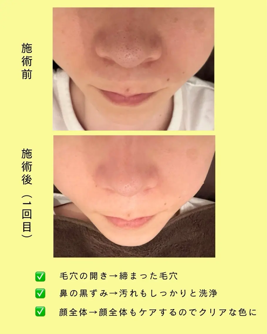 【毛穴・肌荒れ集中⚡️】水素水ハイドロフェイシャル&デコルテケア(ヒアリング込み)の写真