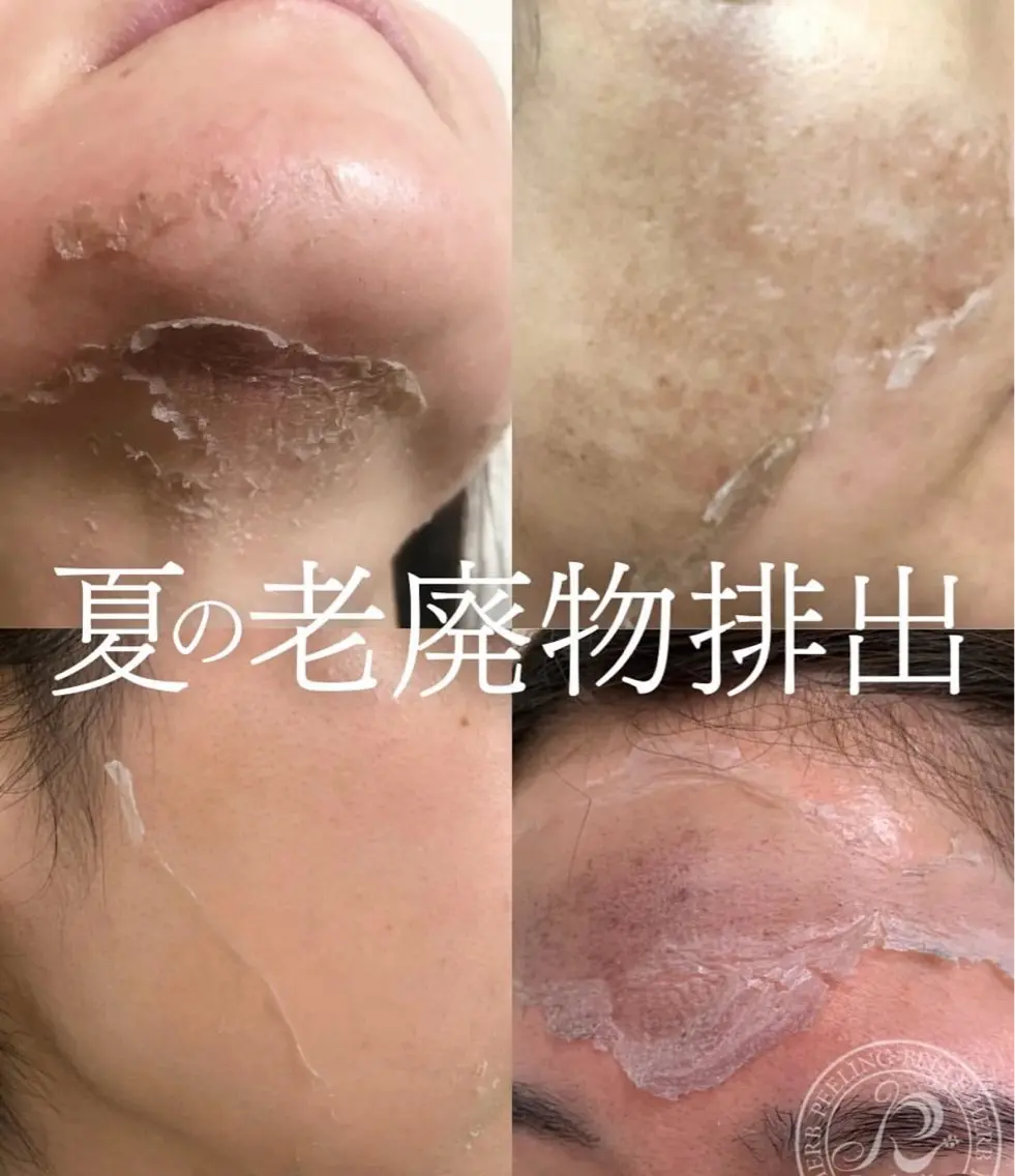 ミニモ価格✨リベルハーブピーリングの写真