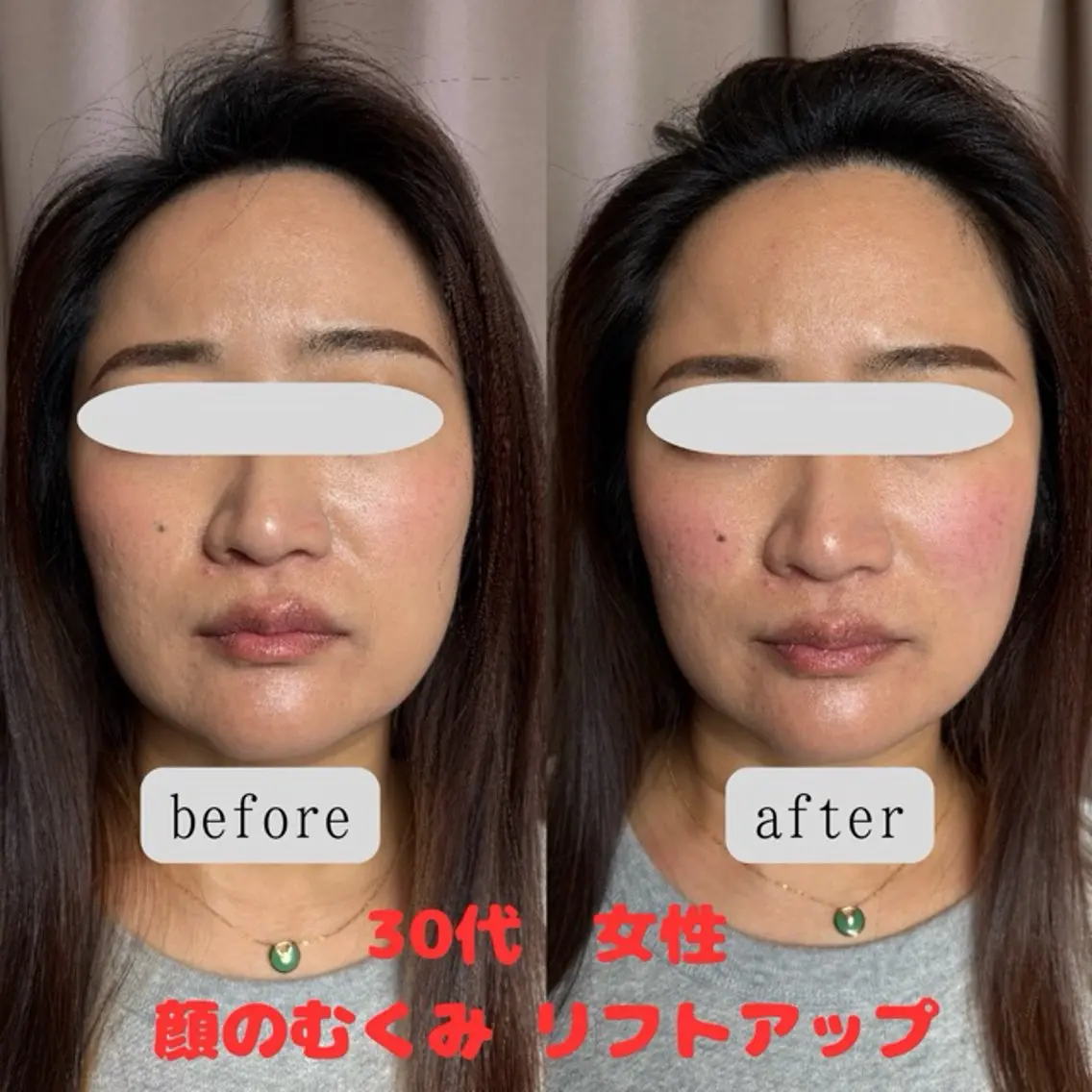 【人気No.1】2回目以降 プレミアム美容鍼＋整体の写真