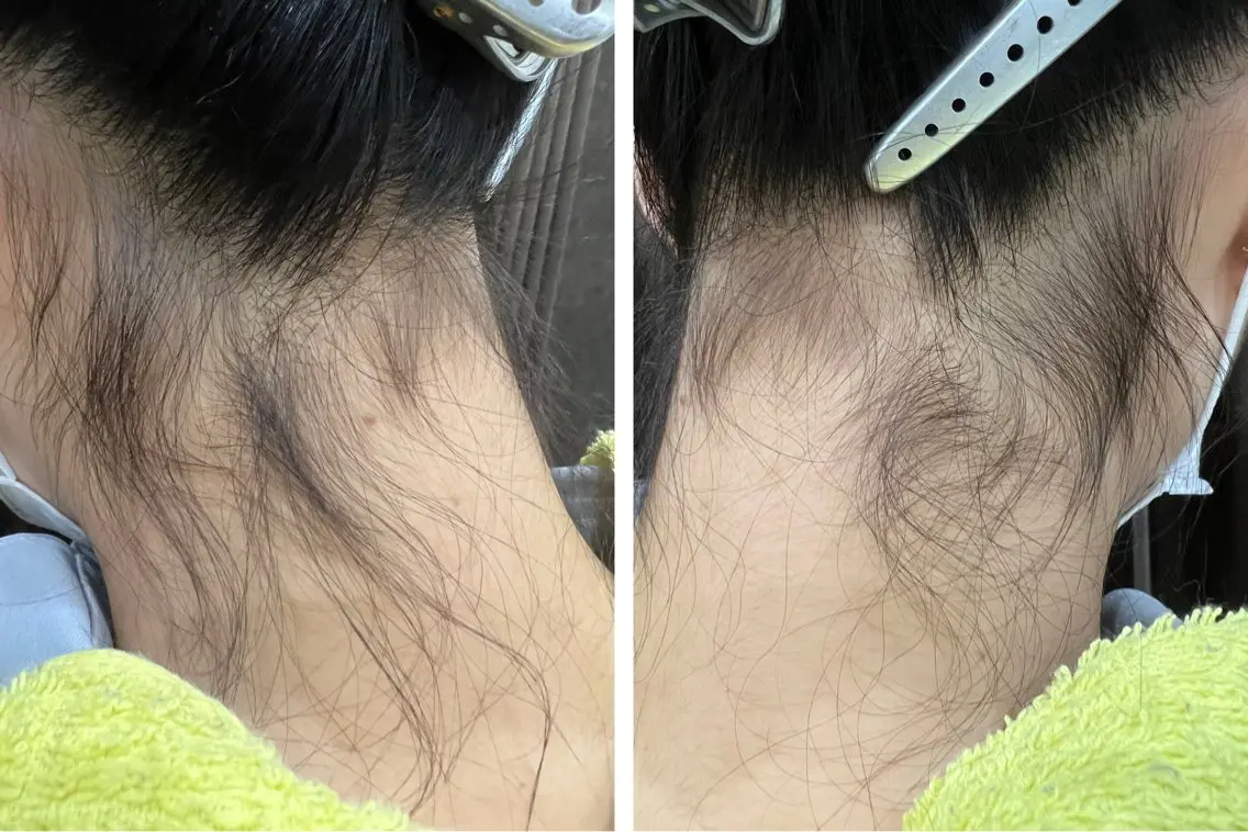 リピート率No.1👑【うなじ脱毛】お得な＼3回分／¥3960／シェービング込み♦︎の写真