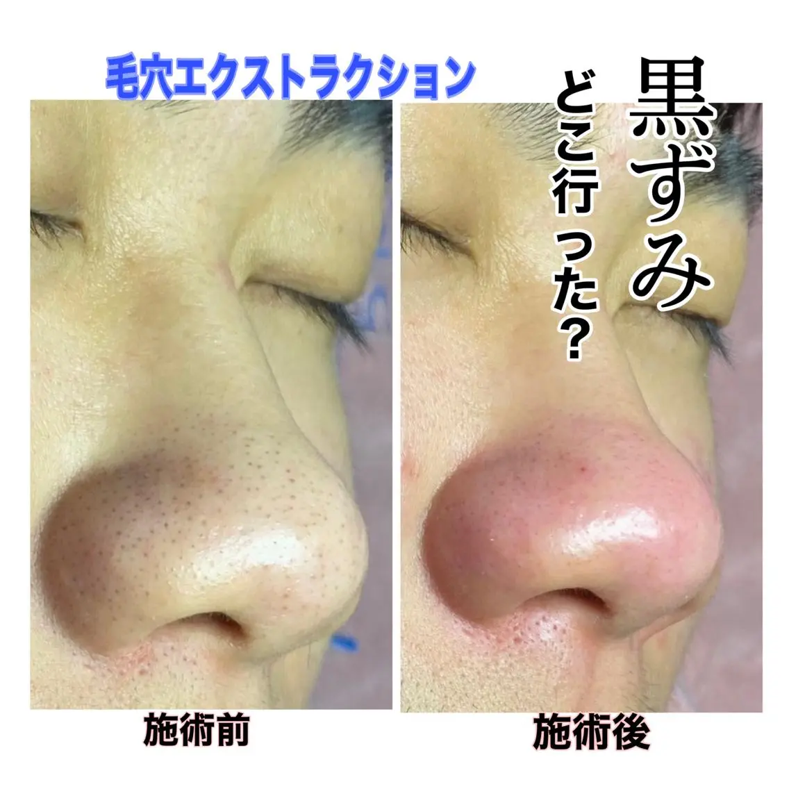 【Pore Skin】【毛穴Skin】 60分!!の写真