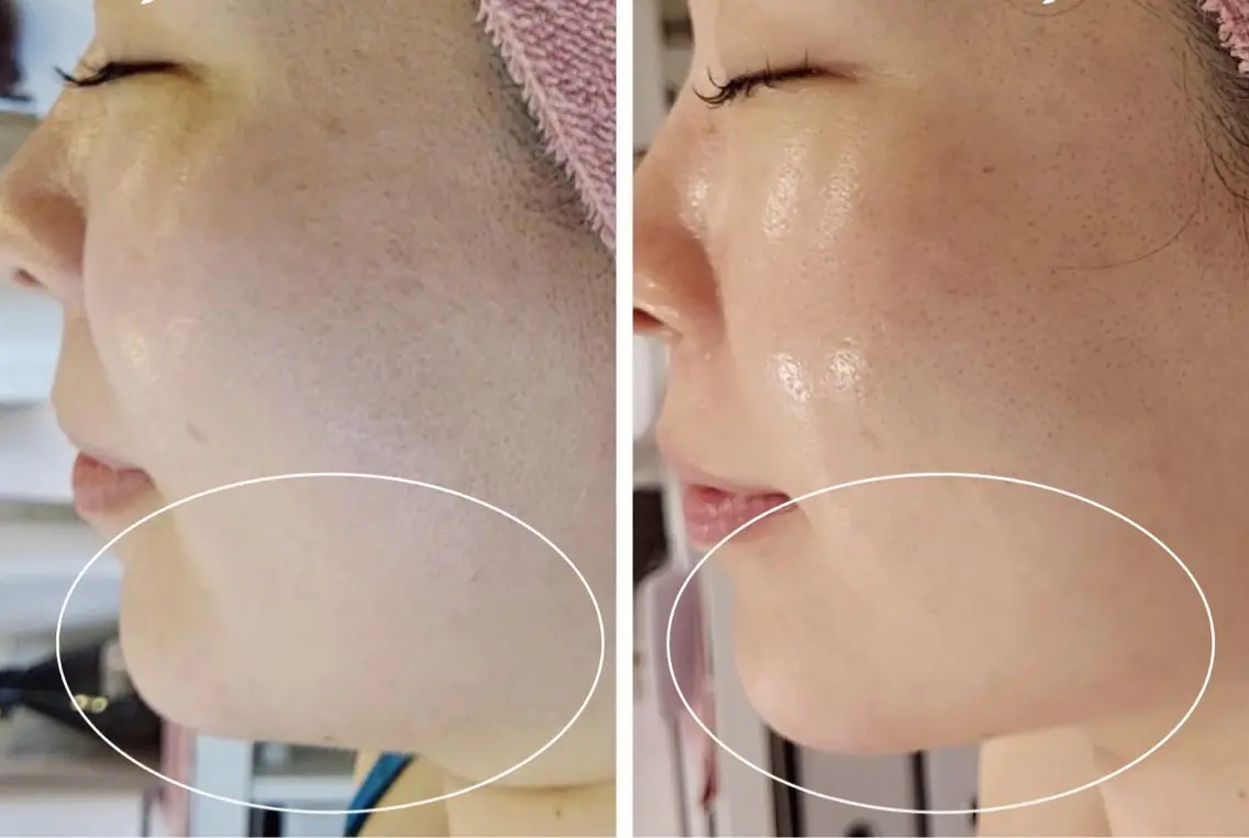 二重あごをグンッと引き上げ✨「切らない！痛くない！」小顔エステ💆‍♀️の写真