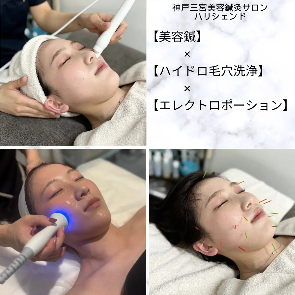 人気No,2美肌と小顔が一度に叶う【美容鍼】×【ハイドラ毛穴洗浄】×【小顔矯正】×【エレクトロポレーション】約60分の写真