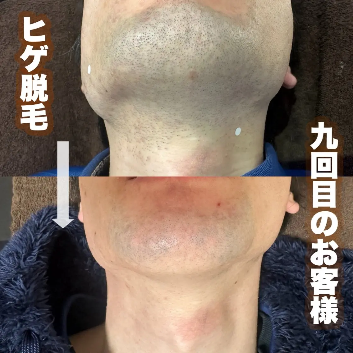脱毛 gift あすかのマツエク・マツパデザイン