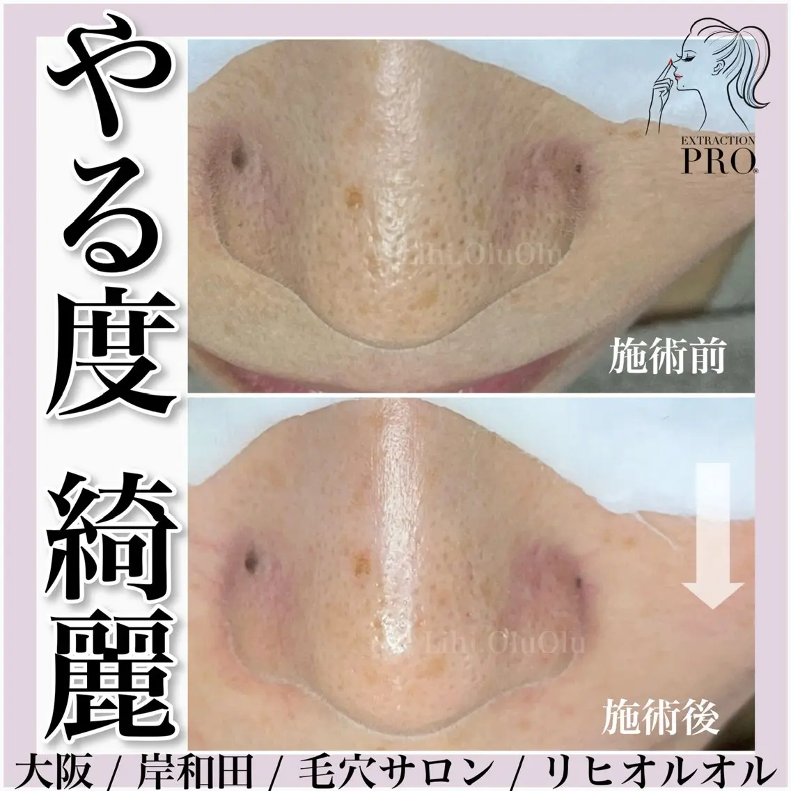 毛穴汚れ改善専門店/ 岸和田/リヒオルオルのエステ・リラクイメージ