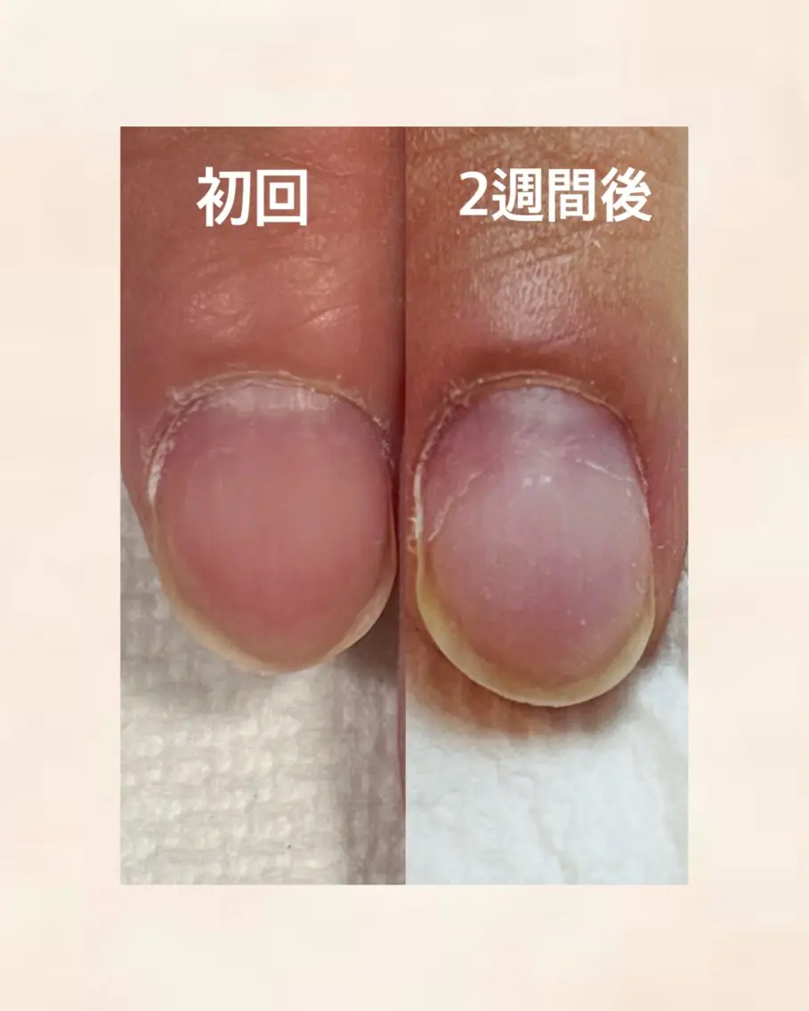 自爪矯正(初回)の写真