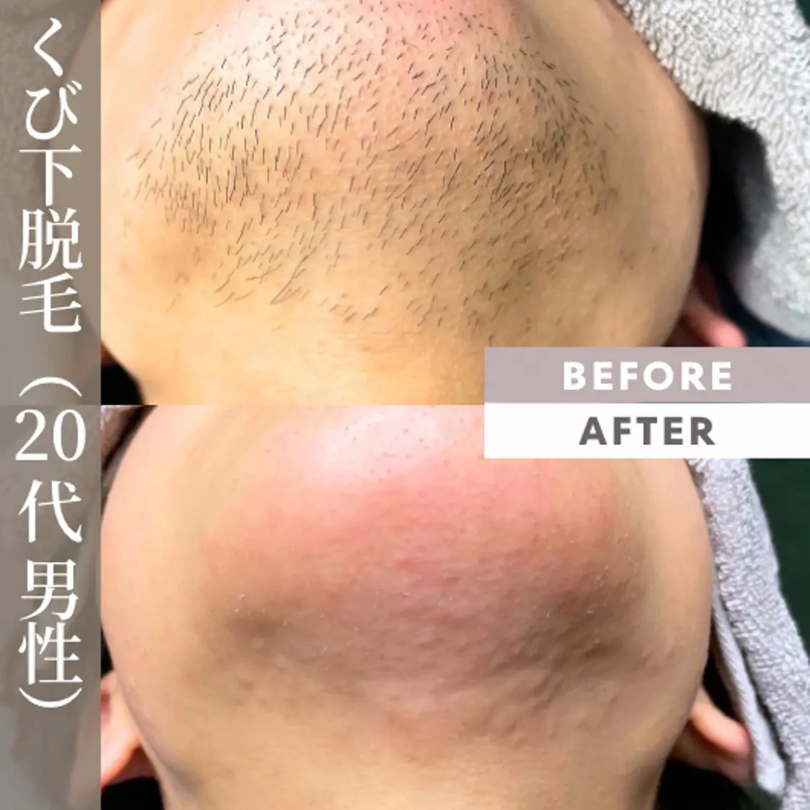 メンズ 【一本ずつ脱毛】 ReMove 柏のエステ・リラクイメージ