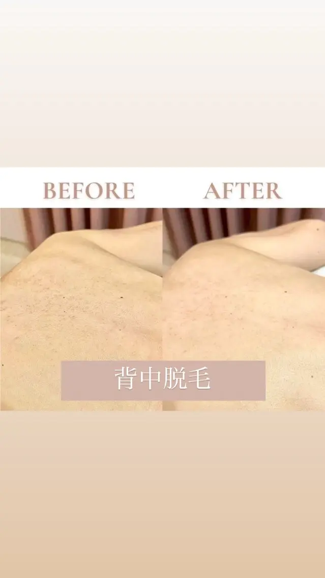 【自己処理しにくいところも一気に解決!】☀️ドレスライン(背中•うなじ)脱毛☀️の写真