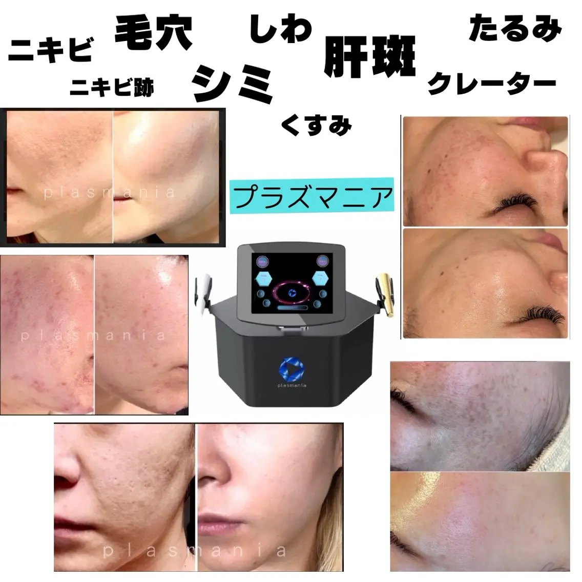 深部にアプローチ。クレーター・肝斑にも◎シミ・シワ・たるみ・ニキビ・ニキビ跡に効果大　¥22,000→¥13,000の写真