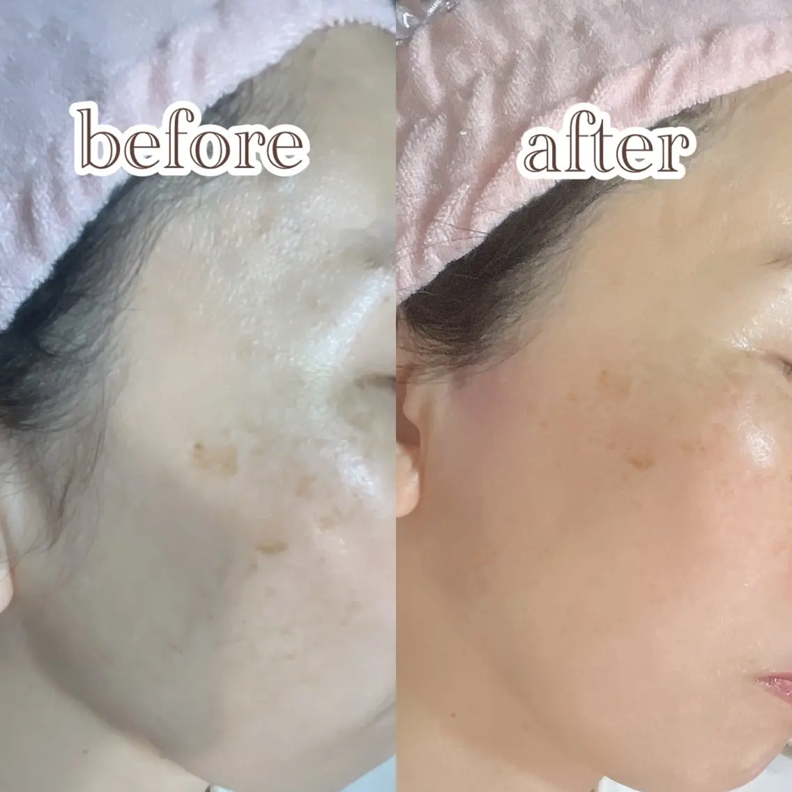 ✨絹肌ヌクレールフェイスワックス＋垢抜け眉WAX＋間引き✨鎮静パック付きの写真