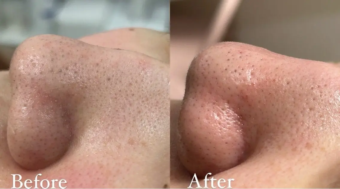 💆🏻‍♀️ハイドラフェイシャル💆🏻‍♀️の写真
