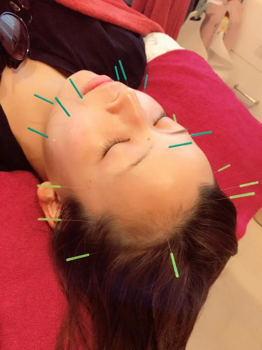 美容鍼(フェイスマッサージ込み)の写真