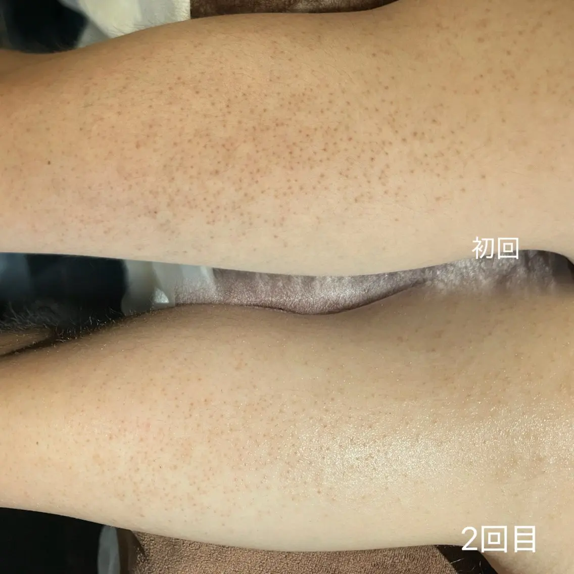 【8月限定！撮影モデル】二の腕ハーブピーリング🌿の写真