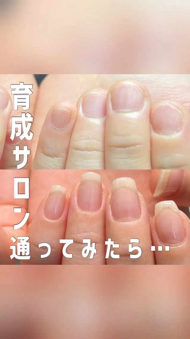 【平日割】自爪・深爪育成【カウンセリング・ケアオイル込】深爪矯正ご検討の方もコチラ✨の写真