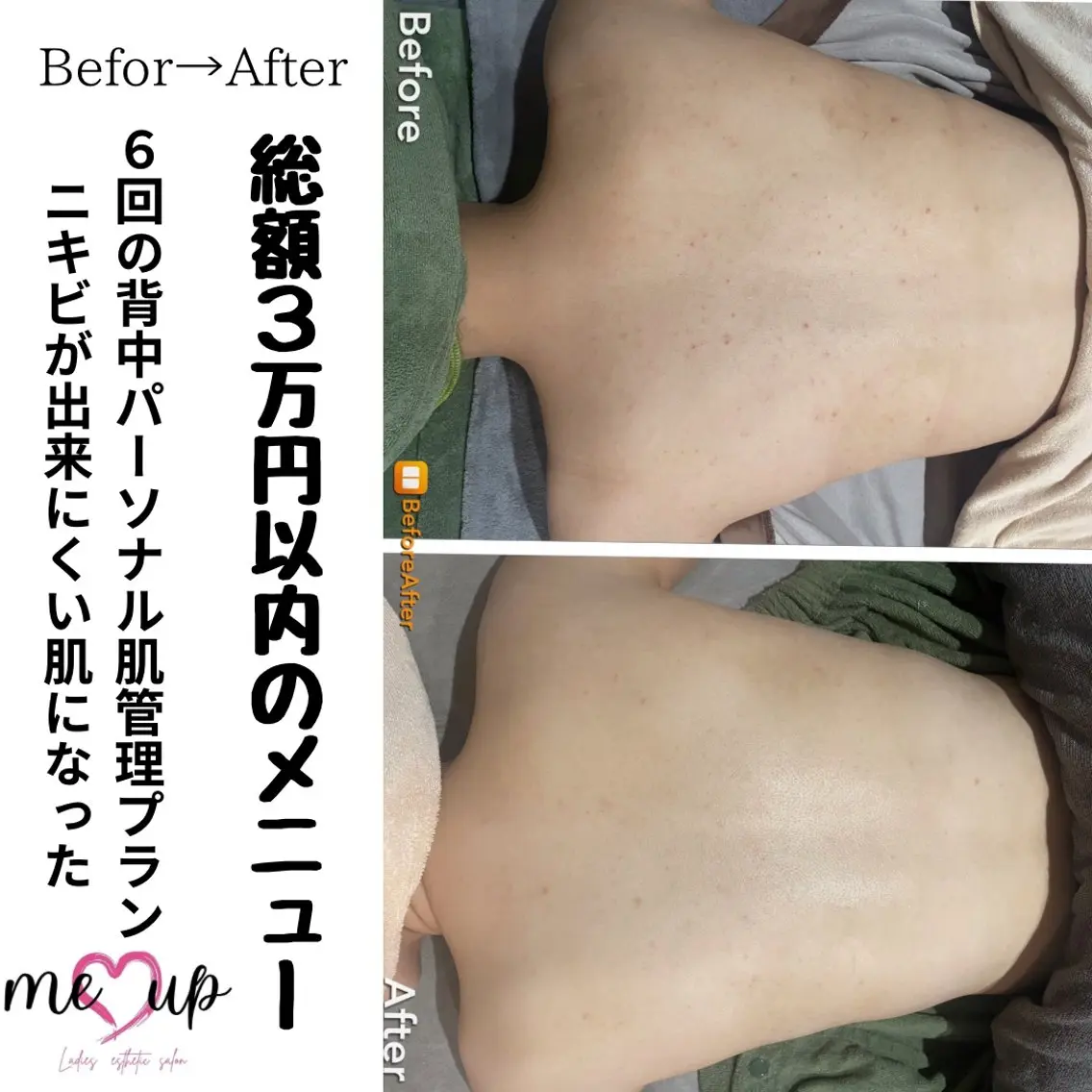 エステ Meupニキビ専門店 背中/ハーブ/肌管理のその他イメージ