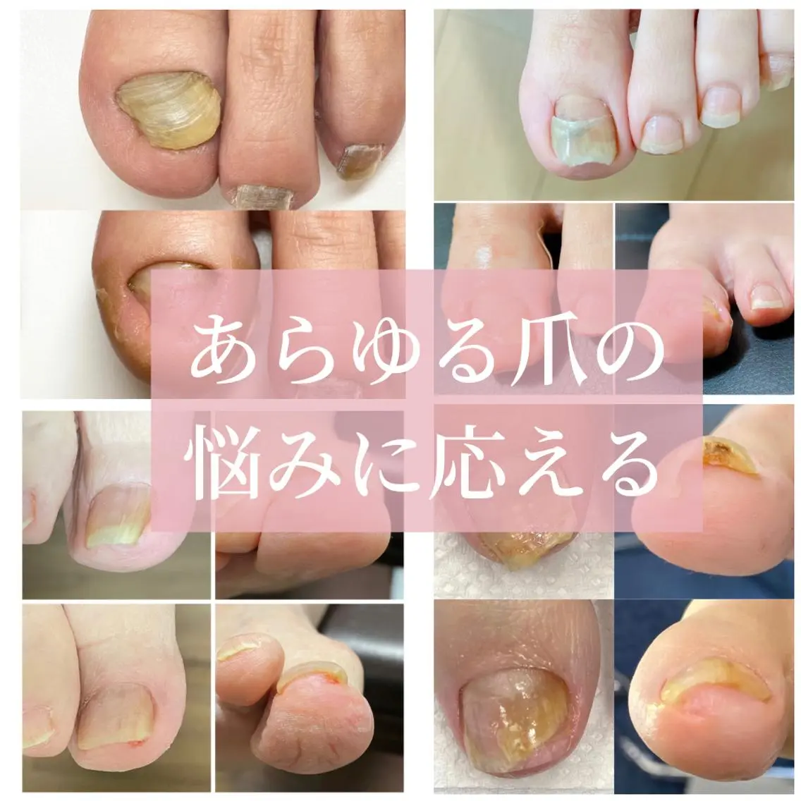 ネイル 深爪・巻き爪 専門サンセリテのネイルデザイン