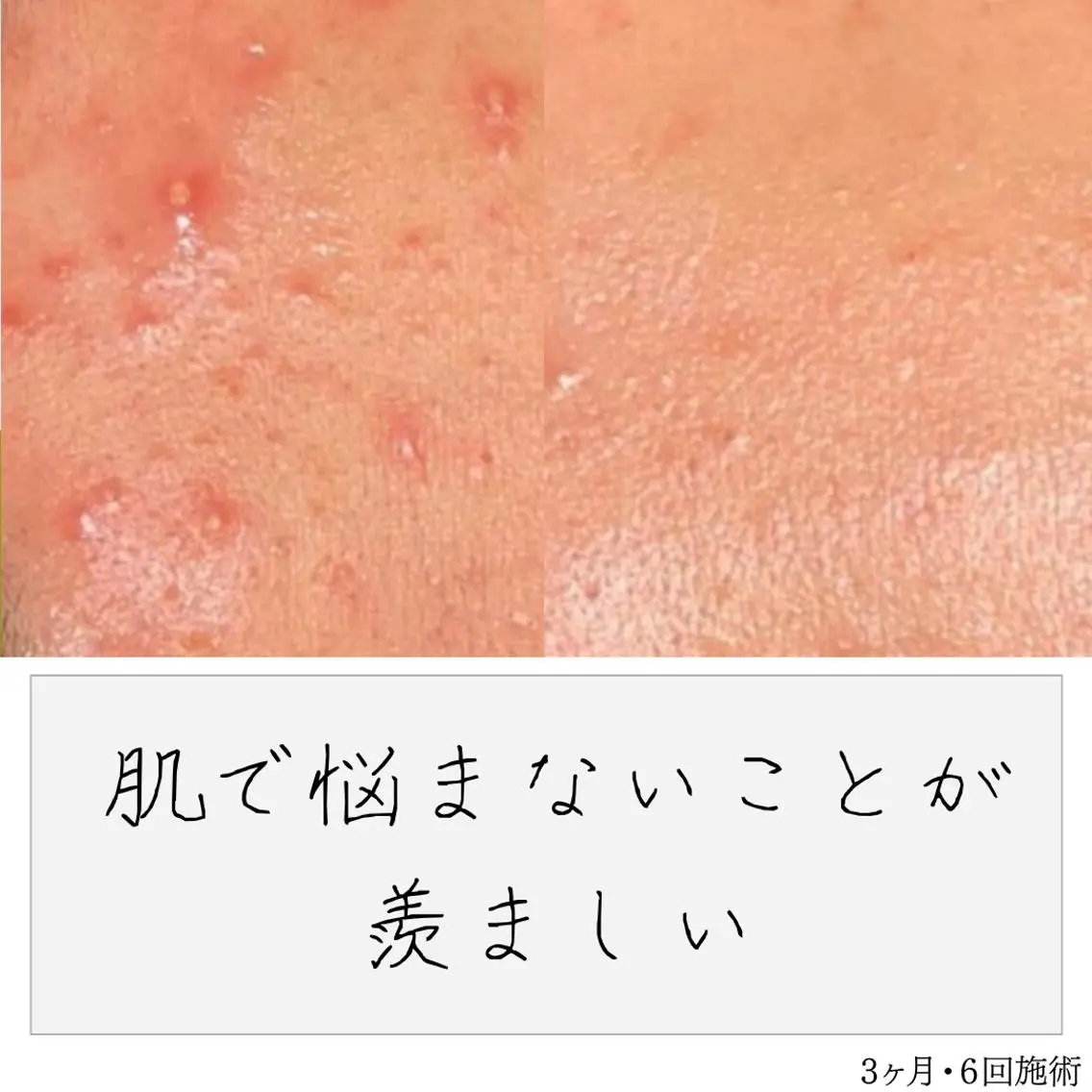 ニキビ経験者が施術 する専門サロン🌻のエステ・リラクイメージ